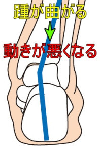 仙台市太白区長町の整体院拓が、かかとが内側に曲がることで偏平足を引き起こし、足底腱膜炎のリスクが高まることを説明しているイラスト。